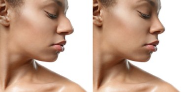 loss face fat benefits