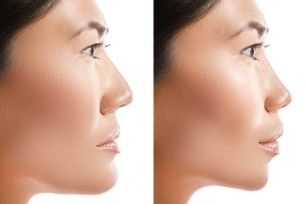 face fat
